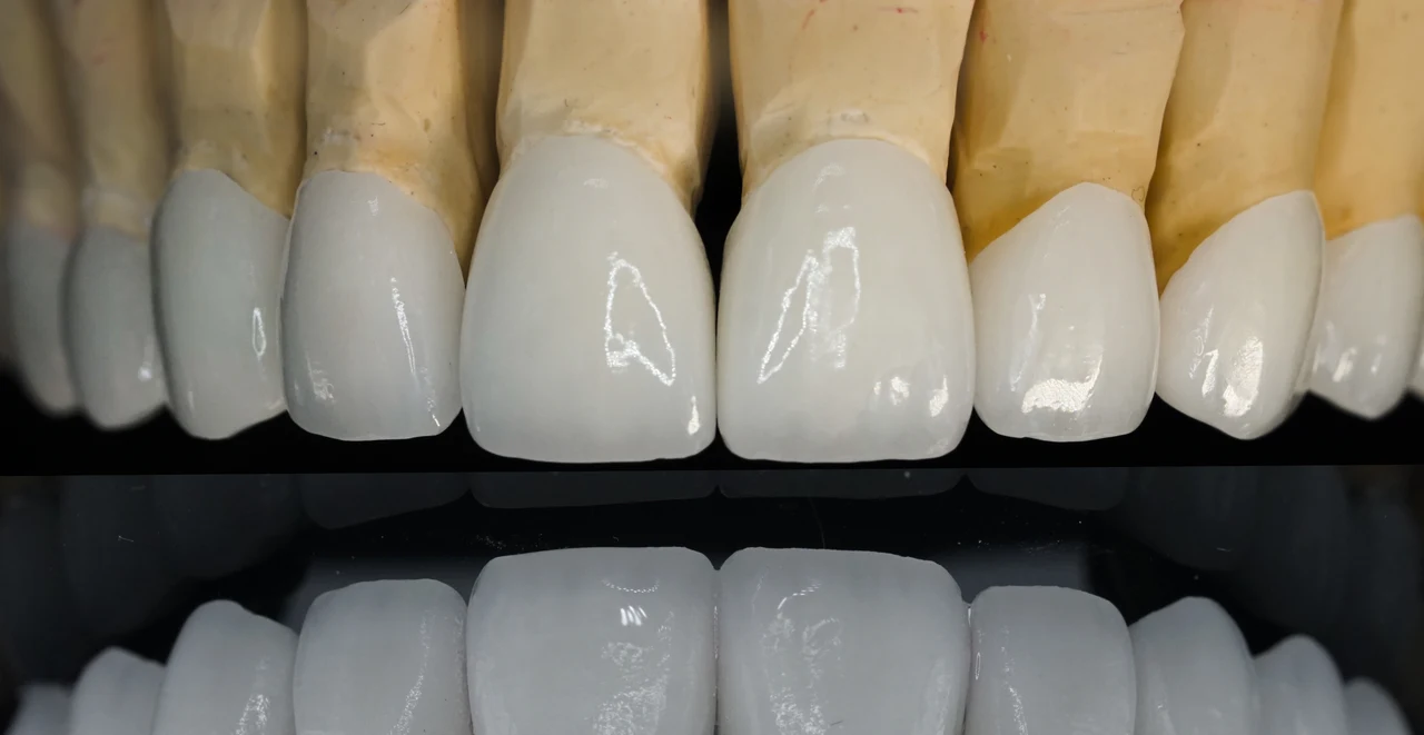 Ceramic restorations on a dental model