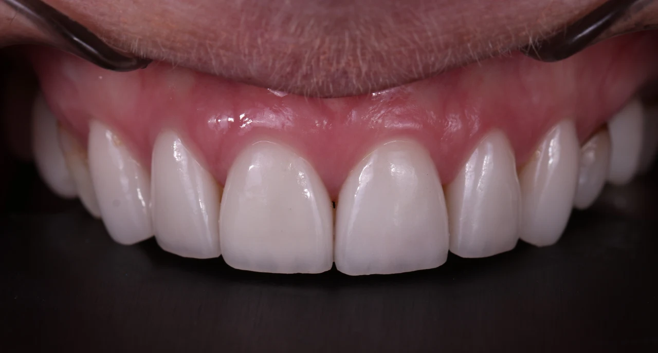 Veneers case, after