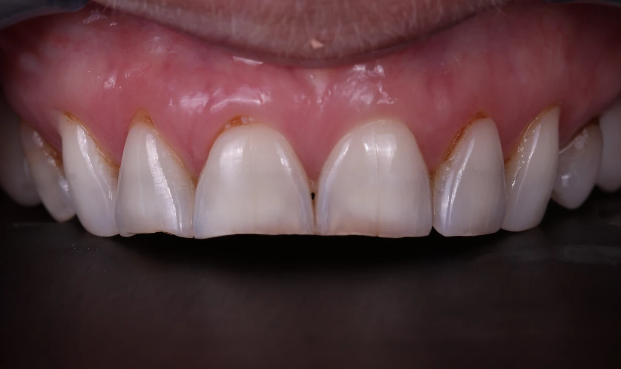 Veneers case, before