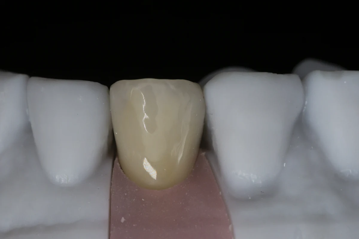 Implant Crowns