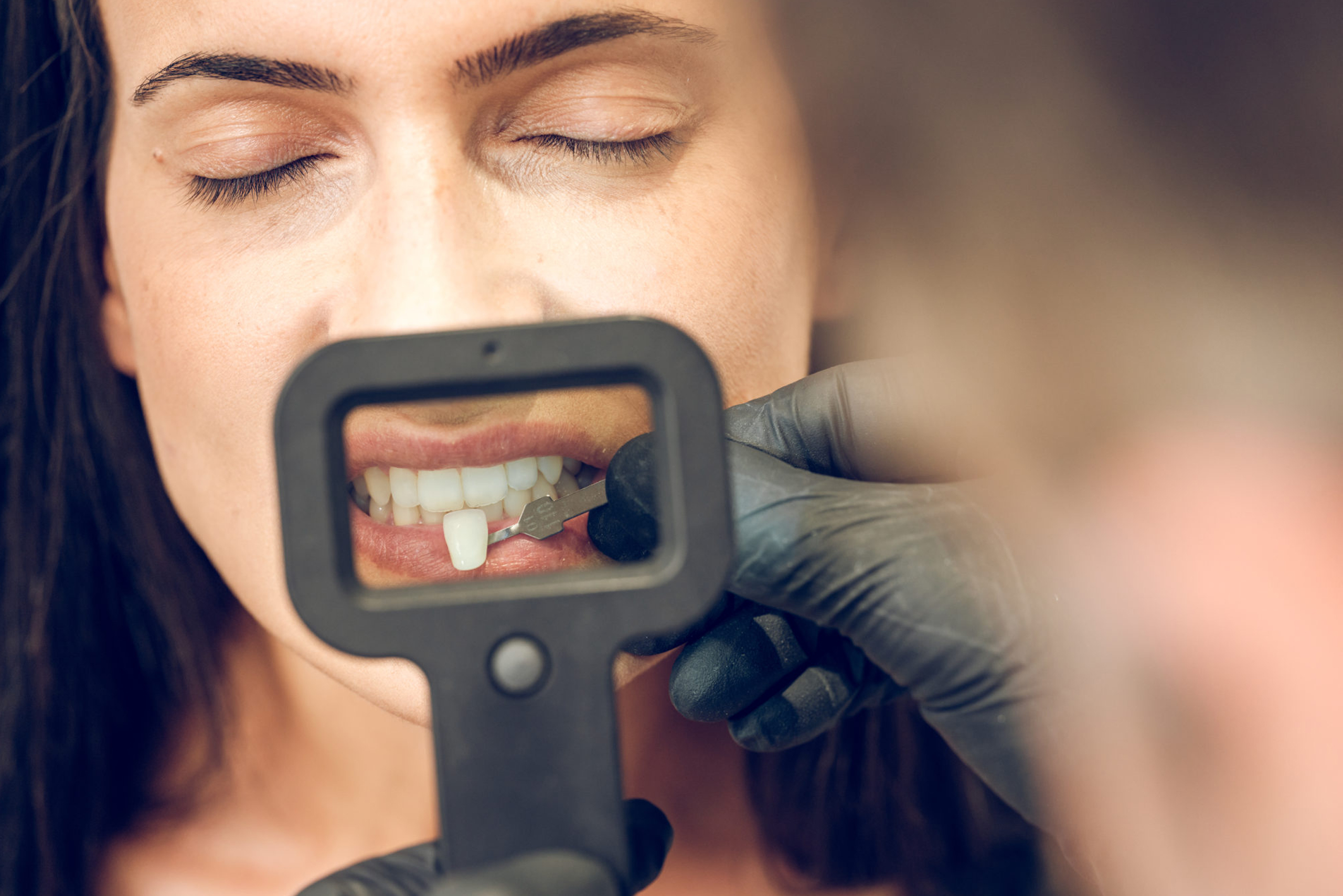 Feldspathic porcelain veneer case from the da Vinci line